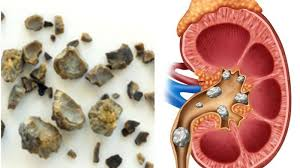 Illustration for article titled Obat Pasca Operasi Batu Ginjal